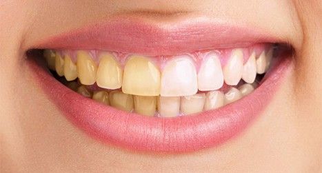 How to Whiten Teeth Using Photoshop
